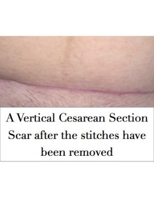 silicone scar sheets for use on cesarean section scars alpha how to use silicone scar sheets