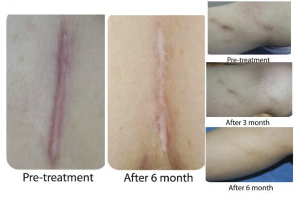 silicone for scars